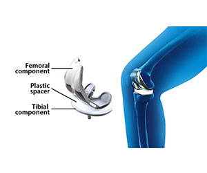 Picture of Total Knee Replacement