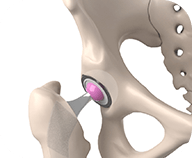 Diagram of a hip joint featuring a pink ball, symbolizing the artificial femoral head in surgery.