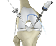Close-up of a knee in a brace, showing recovery from arthroscopy.