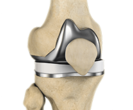 Illustration of a knee joint with a metal plate, showing knee replacement.