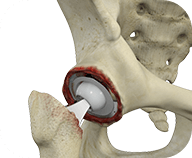 3D illustration of a hip joint, highlighting the ball and socket structure for surgical education.