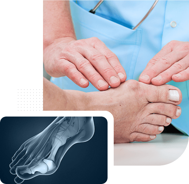 Bunion Surgery Picture