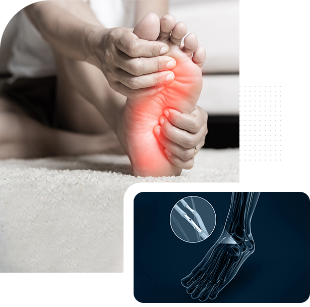 Foot and Ankle Neuropathy Picture