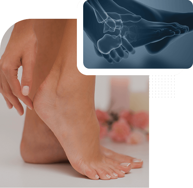 Plantar Fasciitis Picture
