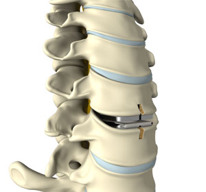 Cervical Arthroplasty - Educational Picture