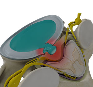 Cervical Disc Herniation - Educational Picture