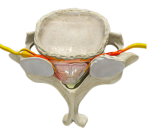 Cervical Stenosis - Educational Picture
