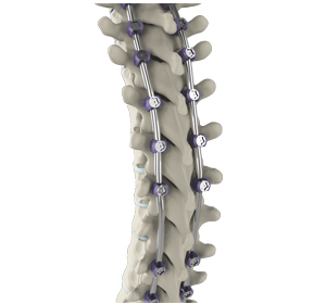 Complex Spinal Reconstruction - Educational Picture