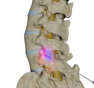 Lumbar Facet Joint Arthropathy - Educational Picture