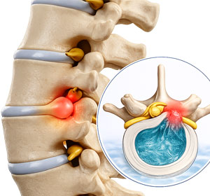 Lumbar Herniated Disc - Educational Picture