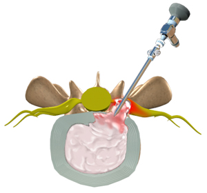 Lumbar Microdiscectomy - Educational Picture