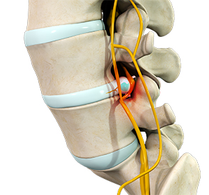 Lumbar Stenosis - Educational Picture