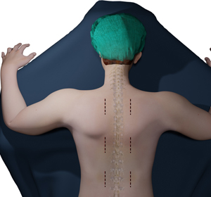 Minimally Invasive Sacroiliac Joint Fusion - Educational Picture