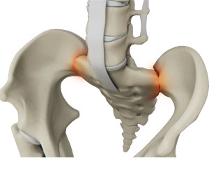Sacroiliac Joint Dysfunction - Educational Picture