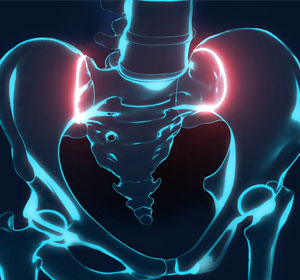 Sacroiliitis - Educational Picture