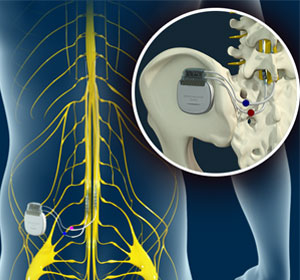 Spinal Cord Stimulator - Educational Picture
