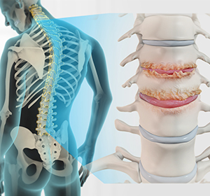 Spinal Stenosis - Educational Picture
