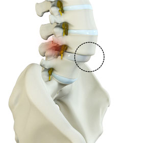 Spondylolisthesis - Educational Picture