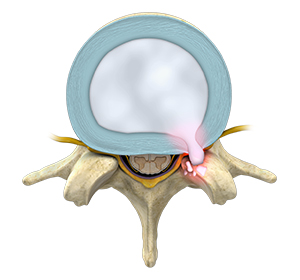 Thoracic Disc Herniation - Educational Picture