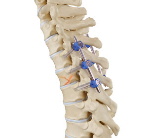 Thoracic Fracture Stabilization - Educational Picture