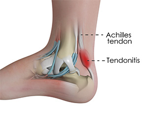 Achilles tendonitis