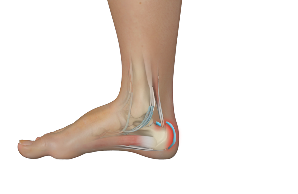 Bursitis