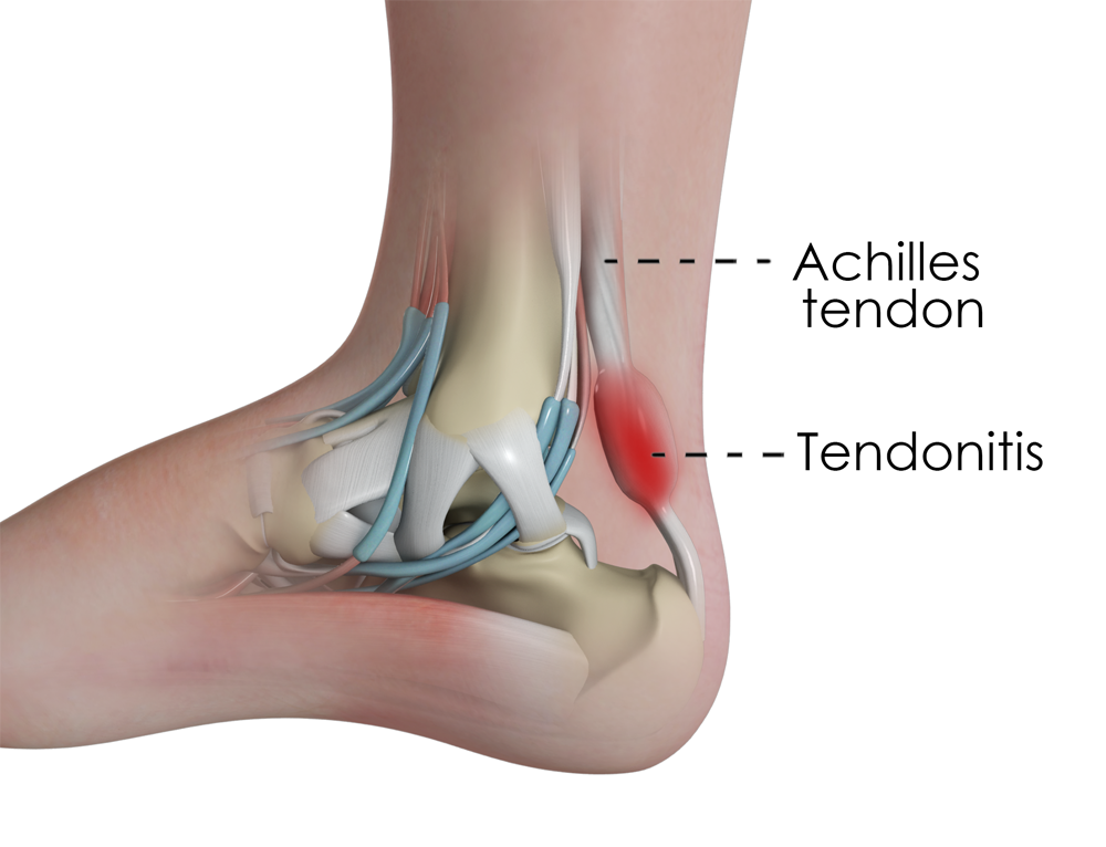 Tendonitis
