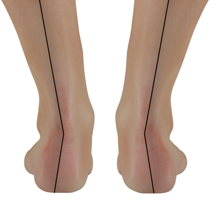 Adult Acquired Flatfoot