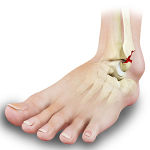 Ankle Fracture