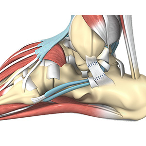 Ankle ligament reconstruction
