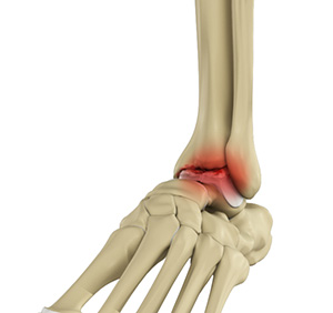 Ankle pain