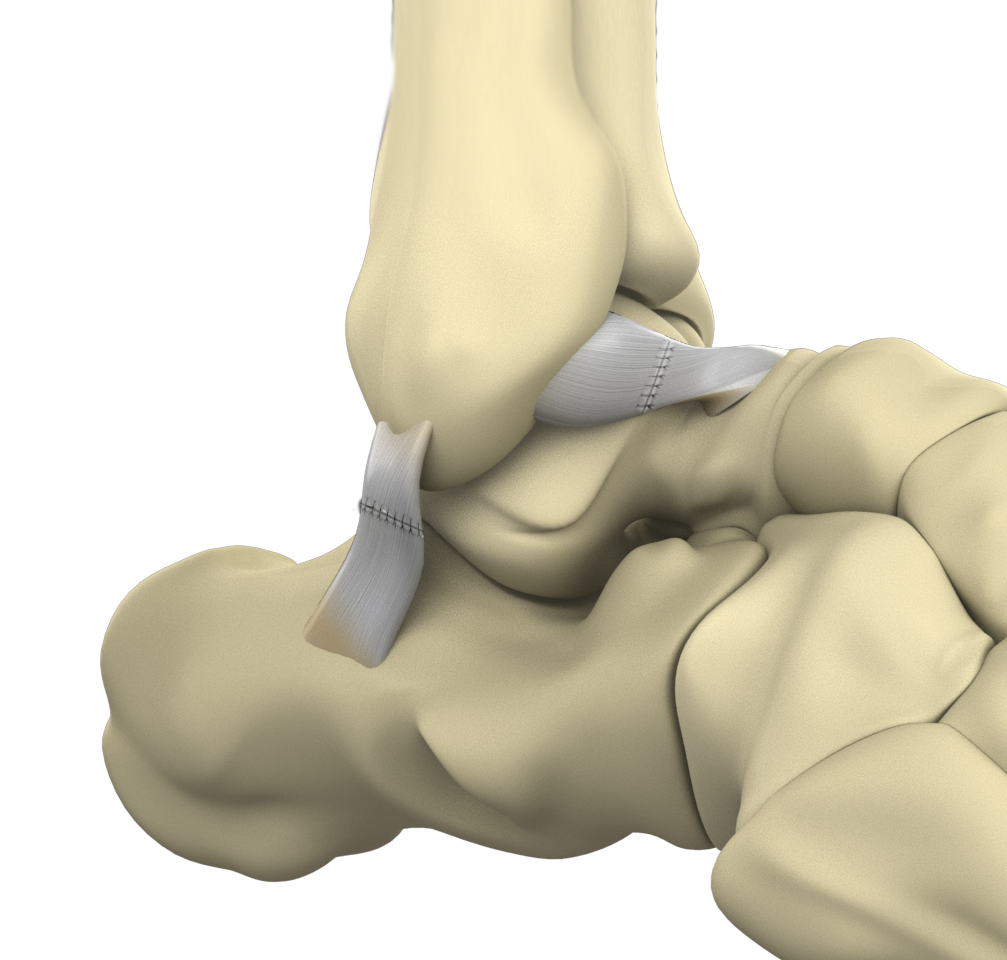 Brostrom procedure