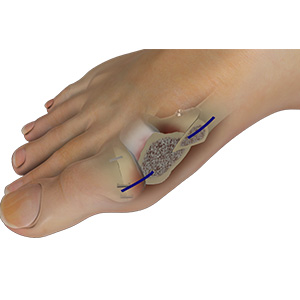 Bunion surgery (bunionectomy)