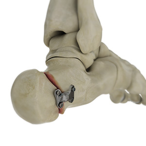 Calcaneal osteotomy