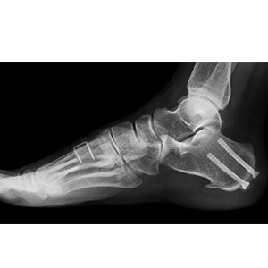 Cavus Foot Reconstruction