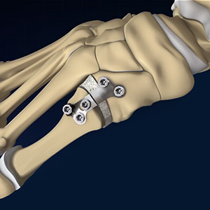 Deformity Correction