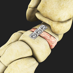 Flatfoot reconstruction