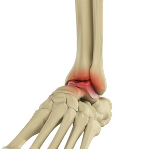 Ankle arthritis