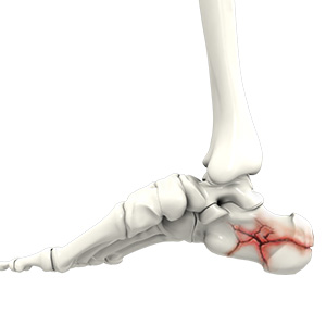 Foot Fracture