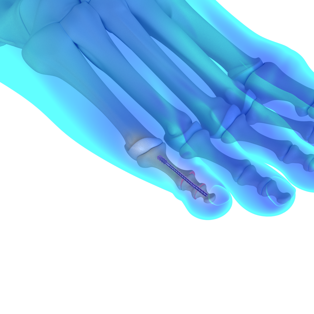 Hammertoe surgery