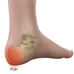 Heel pain