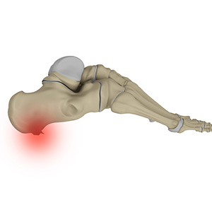 Heel Spurs