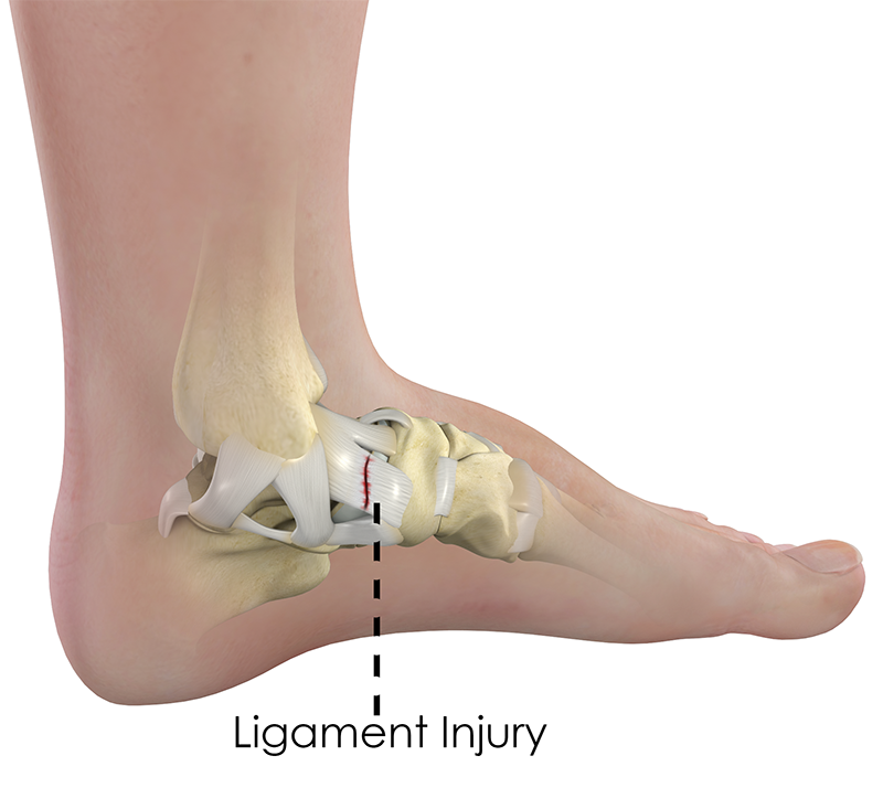 Ligament Injuries