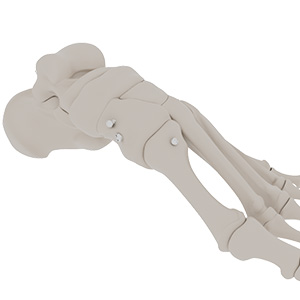 Lisfranc Stabilization