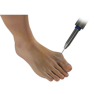 Minimally Invasive Bunion Surgery