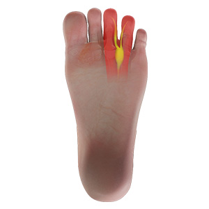 Morton's neuroma