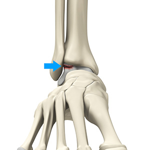 Osteochondral Lesions