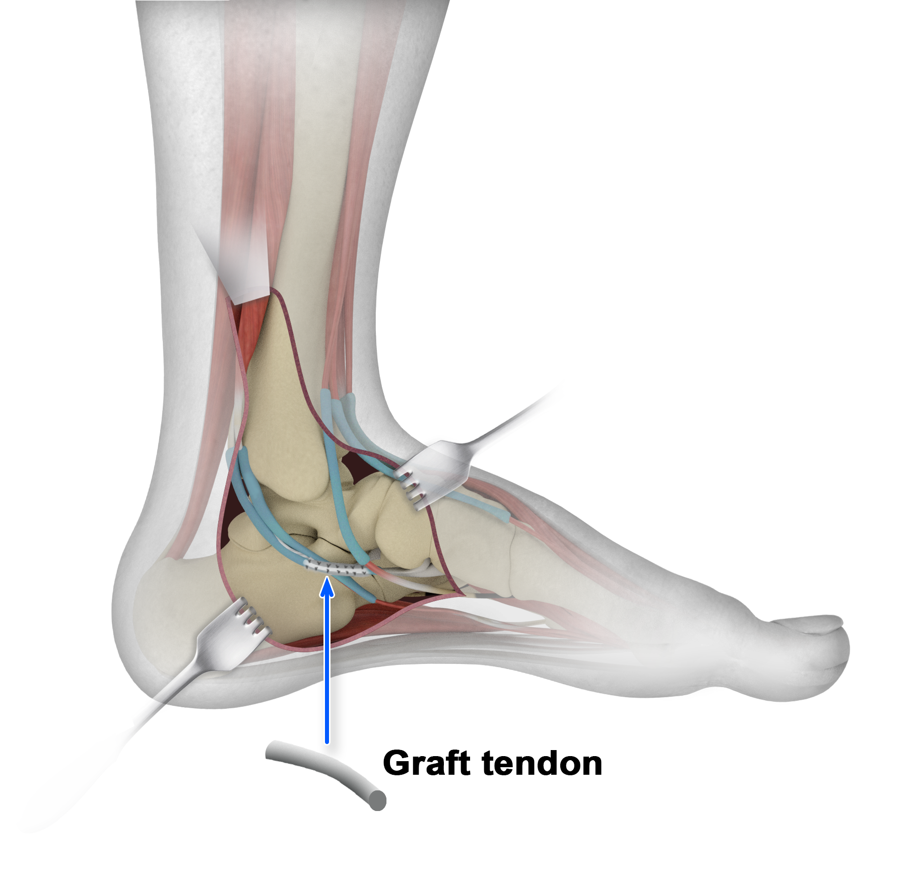 Peroneal tendon surgery