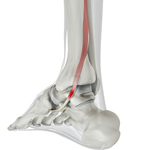 Posterior tibial tendon dysfunction
