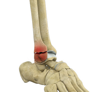 Stress fractures of the Foot